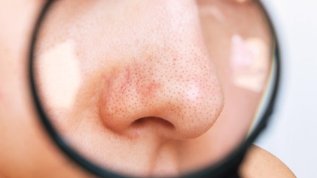 Ako sa zbaviť čiernych bodiek na nose aj inde na tvári ľahko a doma