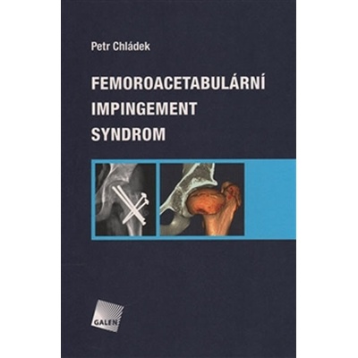 Femoroacetabulární impingement syndrom