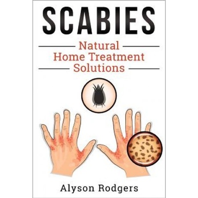 Scabies Natural Home Treatment Solution