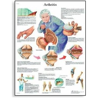 Schéma - artritida - AJ - 50x67 cm Papír s lištou