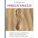 Hallux valgus