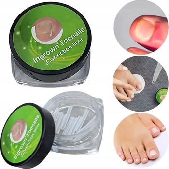 Deni Carte Spona na zarastajúce nechty