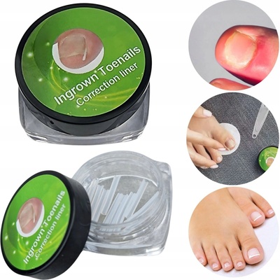 Deni Carte Spona na zarastajúce nechty