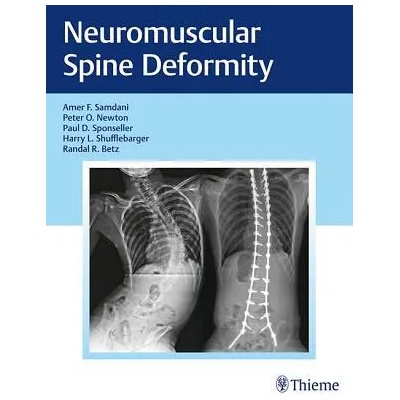 Neuromuscular Spine Deformity | Amer Samdani, Peter O. Newton, Harry L. Shufflebarger, Randal R. Betz