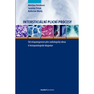 Intersticiální plicní procesy - Martina Vašáková