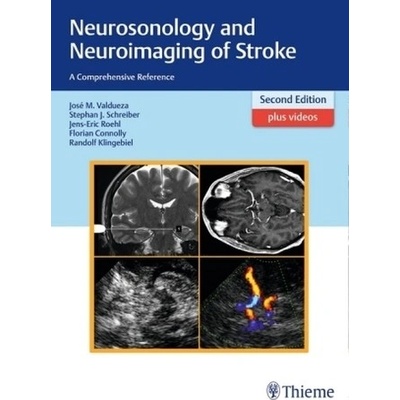 Neurosonology and Neuroimaging of Stroke Valdueza Barrios Jose Manuel