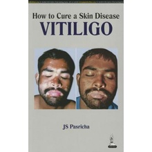 How to Cure a Skin Disease: Vitiligo