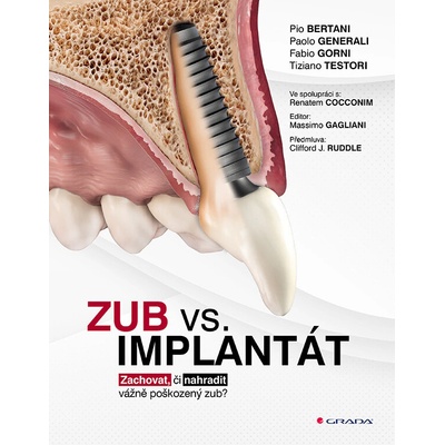 Zub vs. implantát