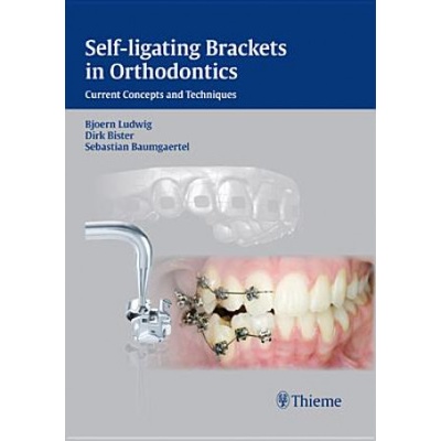 Self-ligating Brackets in Orthodontics