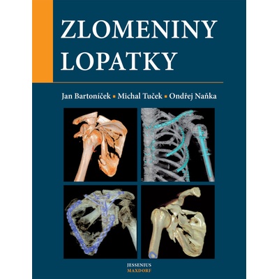 Bartoníček, Jan; Tuček, Michal; Naňka, Ondřej - Zlomeniny lopatky