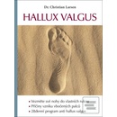 Hallux valgus