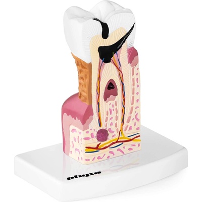 Physa Модел на зъб - болен молар (phy-tm-1)