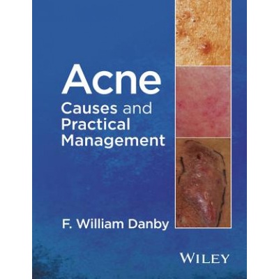 Acne - Causes and Practical Management | F William Danby