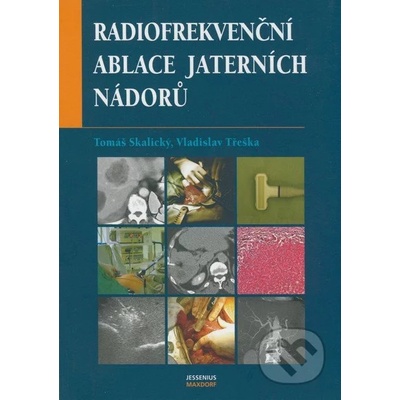 Radiofrekvenční ablace jaterních nádorů