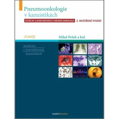 Pneumoonkologie v kazuistikách - Úspěchy a kontroverze v hrudní chirurgii
