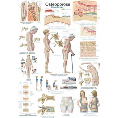 Schéma - osteoporóza Plastová fólia