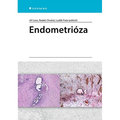 Endometrióza - Luděk Fiala, Lenz Jiří, Chvátal Radek