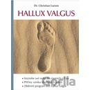 Hallux valgus