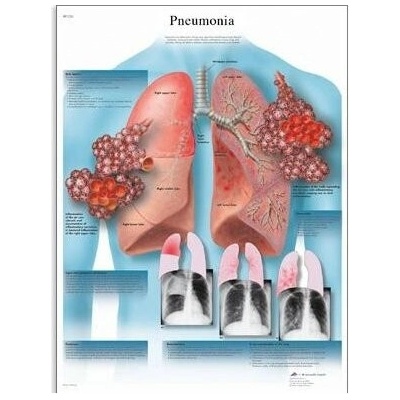 Schéma - pneumonie - AJ - 50x67 cm Papír bez lišty