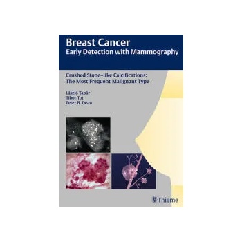 Image 1 of Breast Cancer: Early Detection with Mammography | Laszlo Tabar, Tibor Tot, Peter B. Dean