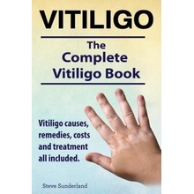 Vitiligo. Vitiligo Causes, Remedies, Costs and Treatment All Included. the Complete Vitiligo Book. Sunderland StevePaperback