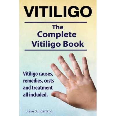 Vitiligo. Vitiligo Causes, Remedies, Costs and Treatment All Included. the Complete Vitiligo Book. Sunderland StevePaperback