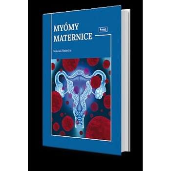 Myómy maternice - Mikuláš Redecha