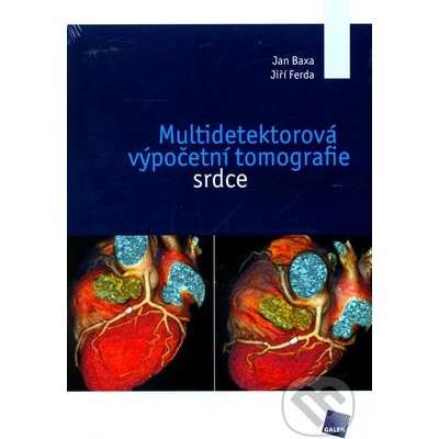 Multidetektorová výpočetní tomografie srdce - Jan Baxa
