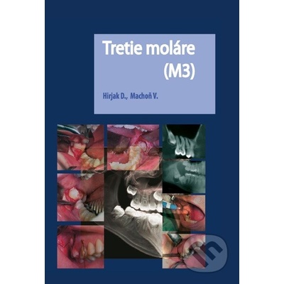 Tretie moláre M3