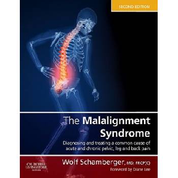 Malalignment Syndrome | Wolf Schamberger