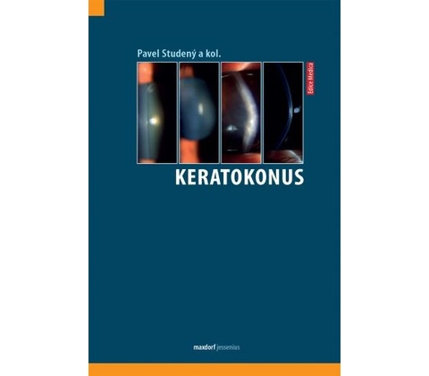Keratokonus