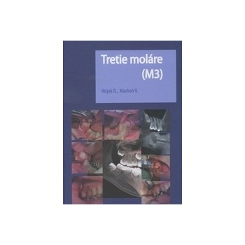 Tretie moláre M3