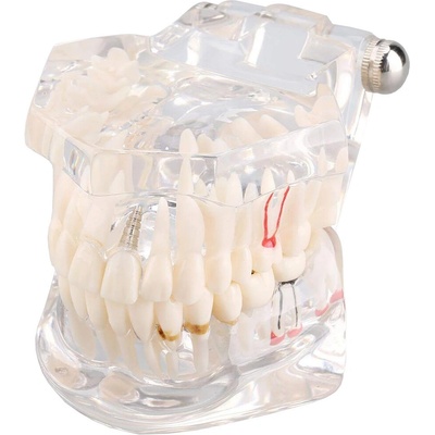 Verk 01964_B Model zubních implantátů bílá