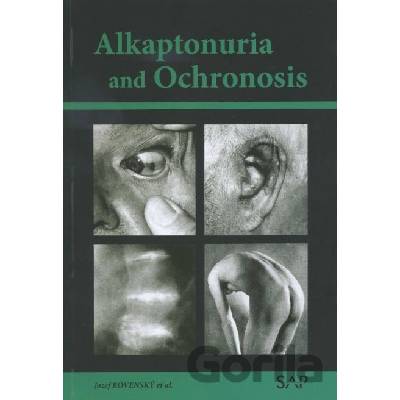 Alkaptonuria and ochronosi - Jozef Rovenský