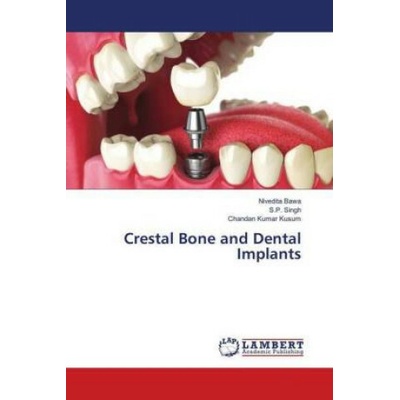 Crestal Bone and Dental Implants Nivedita Bawa,S. P. Singh,Chandan Kumar Kusum