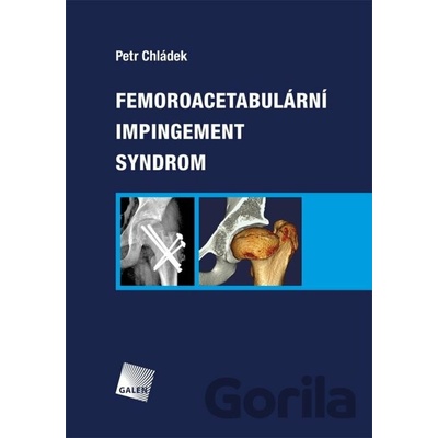 Femoroacetabulární impingement syndrom