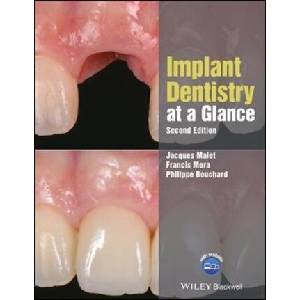Implant Dentistry at a Glance, 2nd Edition | Jacques Malet, Francis Mora, Philippe Bouchard (ISBN: 9781119292609)