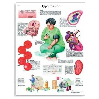 Schéma - hypertenze - AJ - 50x67 cm Papír s lištou