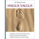 Hallux valgus