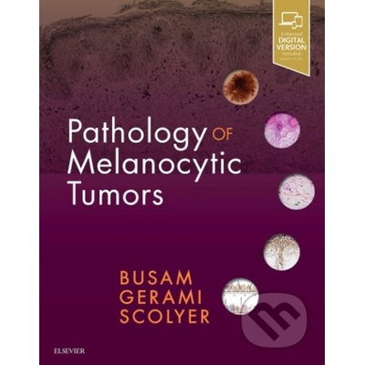 Pathology of Melanocytic Tumors