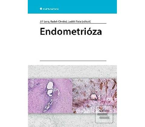 Endometrióza