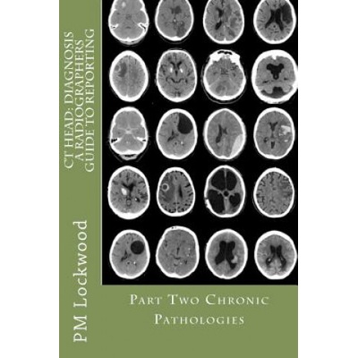 CT Head: DIAGNOSIS A Radiographers Guide To Reporting Part 2 Chronic Pathologies: Part 2 Chronic Pathologies (P M Lockwood)()