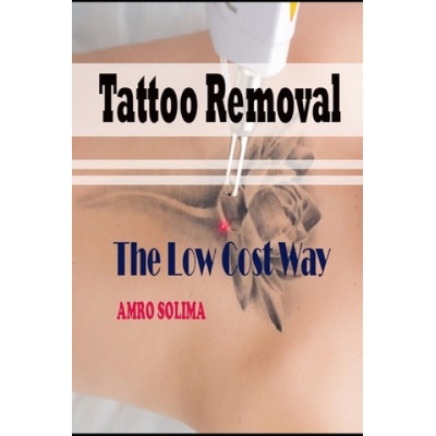 Tattoo Removal: The Low Cost Way