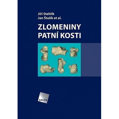 Zlomeniny patní kosti - Jiří Stehlík, Jan Štulík et al.