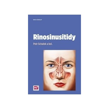 Rinosinusitidy