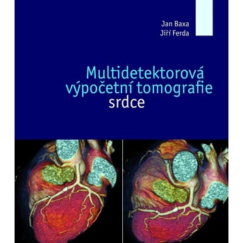 Multidetektorová výpočetní tomografie srdce
