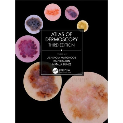 Atlas of Dermoscopy