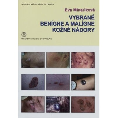 Vybrané benígne a malígne kožné nádory - Eva Mináriková