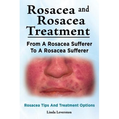 Rosacea and Rosacea Treatment. From A Rosacea Sufferer To A Rosacea Sufferer. Rosacea Tips And Treatment Options | Linda Leverston