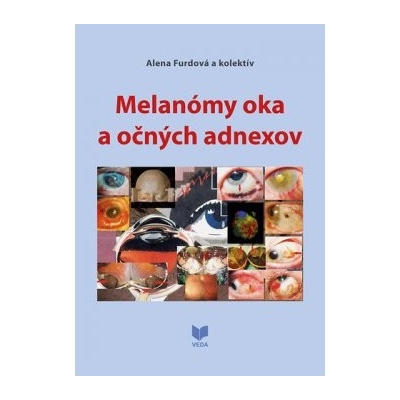 Melanómy oka a očných adnexov